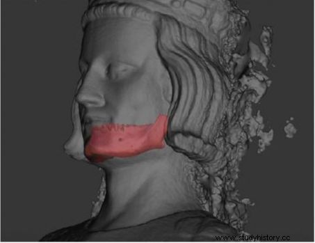セントルイスの死の原因はペストではなく壊血病 