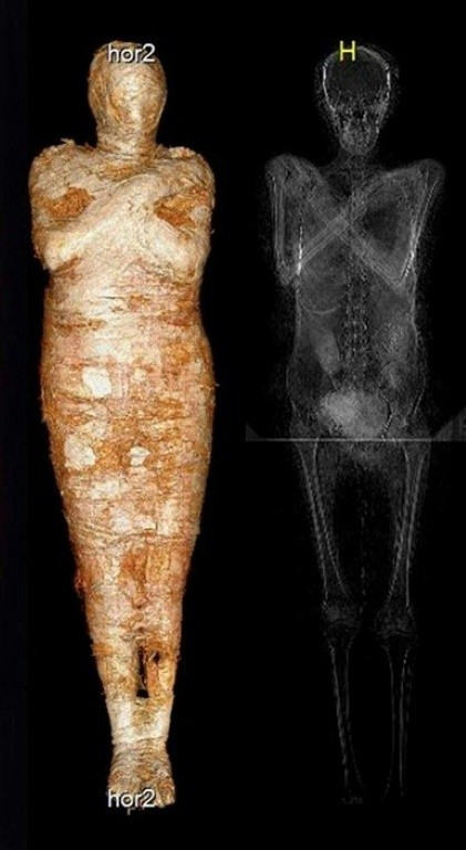 과학자들이 세계 최초로 임신한 이집트 미라를 발견했습니다. 